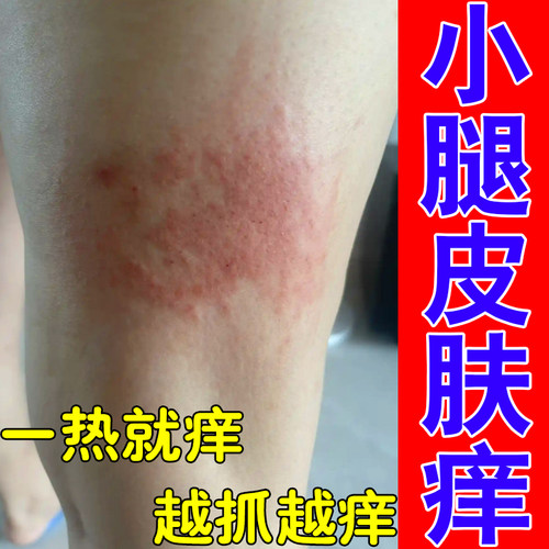 小腿痒皮肤干燥粗糙起红疙瘩痒药