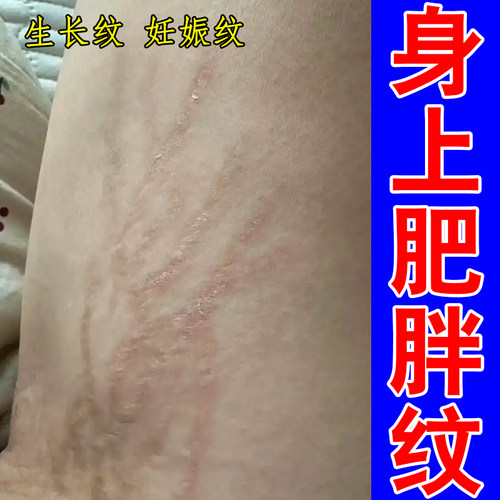 去肥胖纹修复霜去除青少年大腿学生肥胖生长纹白色红色纹路药乳膏