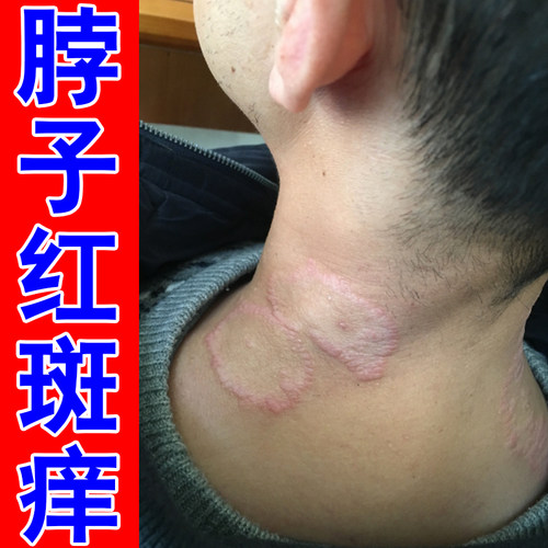 脖子红斑痒后面长红疙瘩掉屑脱皮神经性起痘刺挠出汗痒