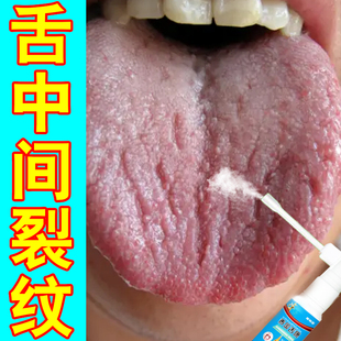舌头裂痕地图舌齿痕舌调理灼口综合症裂纹有齿痕舌苔白厚冶烂嘴药