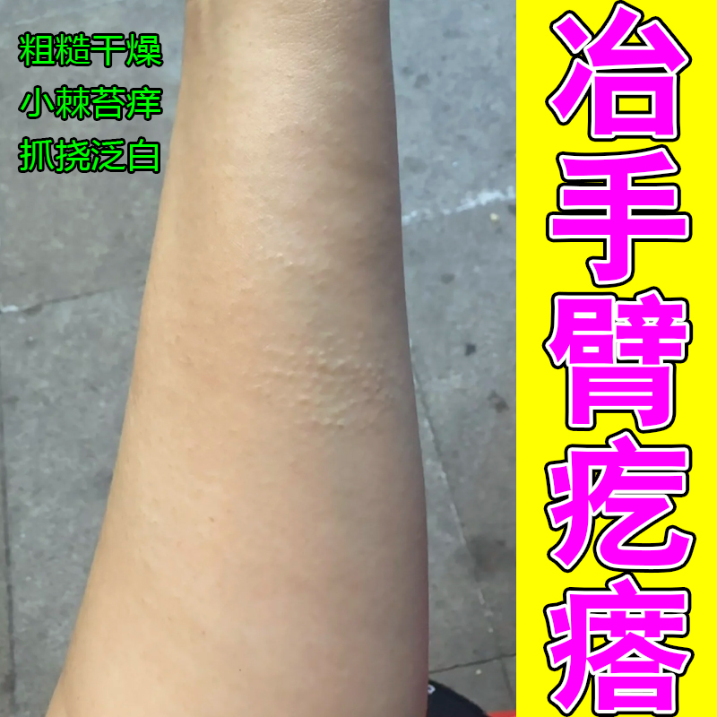 冶手臂疙瘩白色粗糙颗粒皮肤干燥痒抓挠起皮起干皮专用修复保湿药