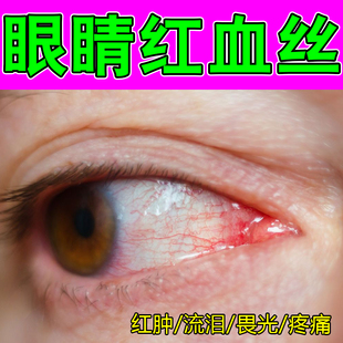 眼睛红血丝眼屎多糊眼眼睛淤血视力模糊黄斑眼里有异物黄斑滴眼液