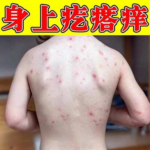 治身上皮肤痒长小红点前胸后背全身起红疙瘩长痘痘肤痒外用修复膏