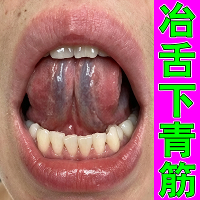 冶舌下青筋又黑又粗草本修护喷剂舌头下有淤血堵塞发青紫严重