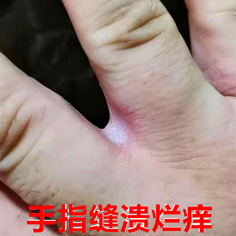 治疗手指缝溃烂膏药经常碰水手指中间发白糜烂脱皮瘙痒烂手丫专用