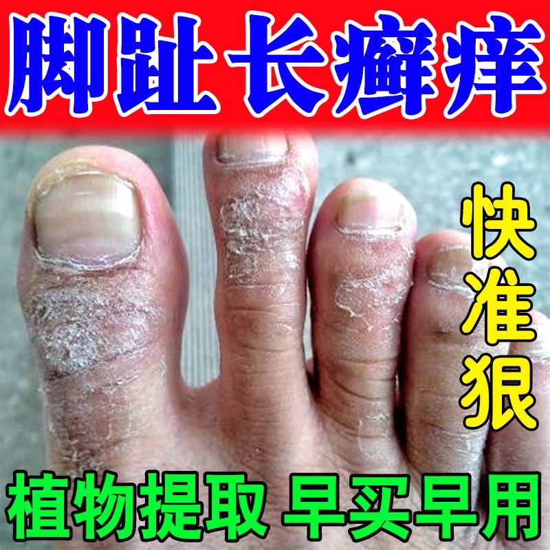 脚趾头上长癣痒脚指关节藓皮肤真菌感染脚面皮炎脚癣足藓专用药
