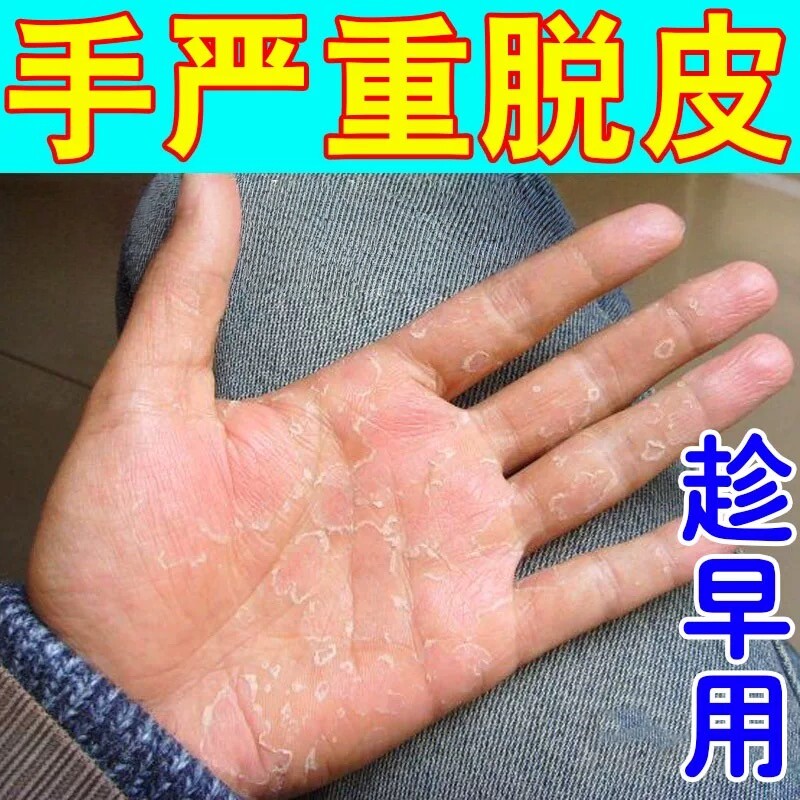 手脱皮专用药膏手掌严重蜕皮褪皮干燥起皮痒去手心死皮保湿护手霜