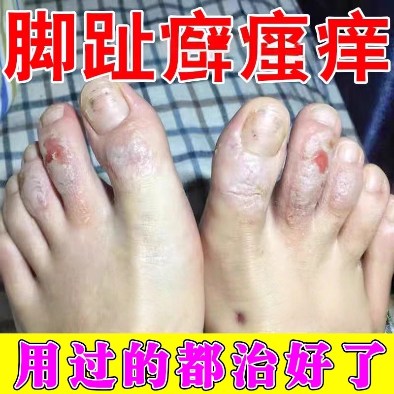 脚趾头很痒脱皮真菌感染发黑起硬疙瘩脚指关节癣足藓干燥起修复膏