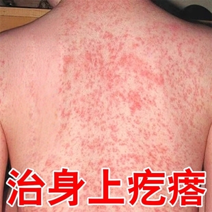 身上起红疙瘩痒热疹皮肤发痒起红点红肿疙瘩长小水泡皮肤过敏痒药