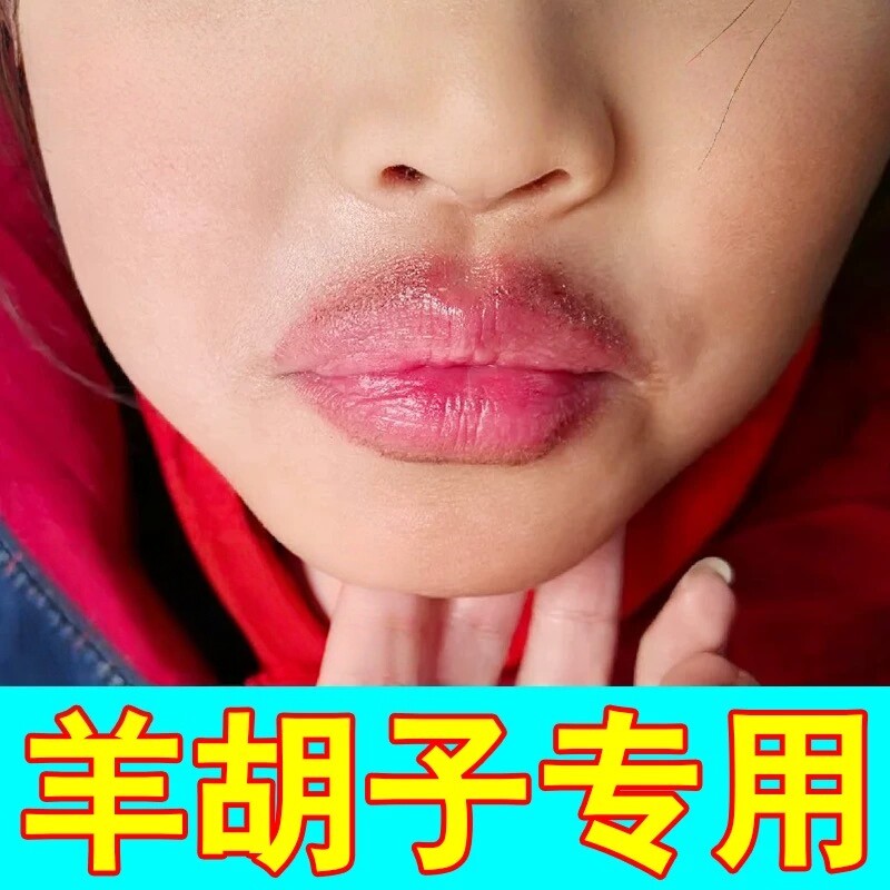 去羊胡子疮小孩嘴巴一圈红嘴周泛红舔嘴唇上火起水泡口周炎修复膏