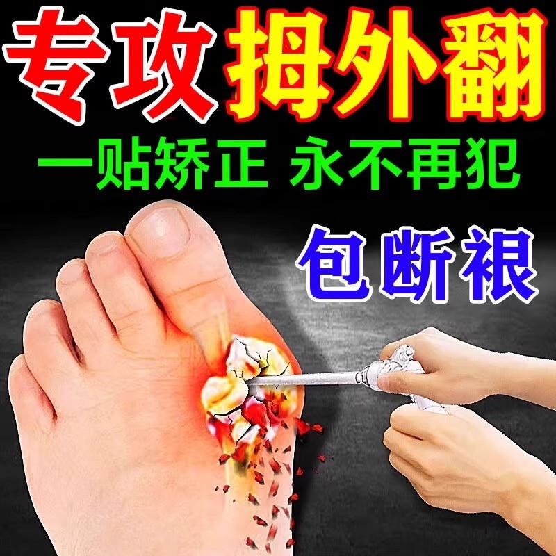 【已愈万人】拇外翻贴脚趾重叠防磨大脚骨拇指外翻矫正膏贴
