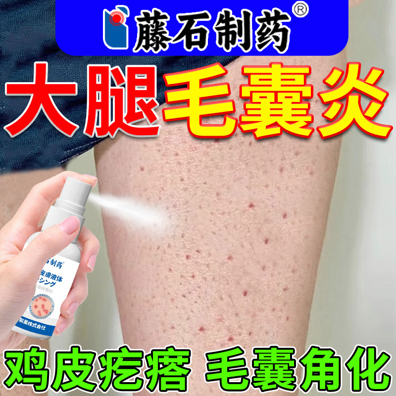 腿部毛囊炎专用喷剂大腿长痘痘毛囊角化鸡皮肤粗糙瘙痒可搭软膏AZ