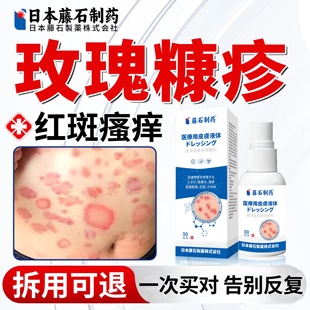 玫瑰糠疹专用根喷雾除糠疹软膏治疗皮肤瘙痒红斑疹止痒药房同售ZR