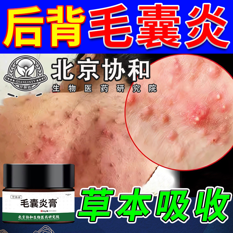马拉色菌药毛囊炎搭药膏背上长痘痘后背毛囊炎痤疮疙瘩除螨止痒ol