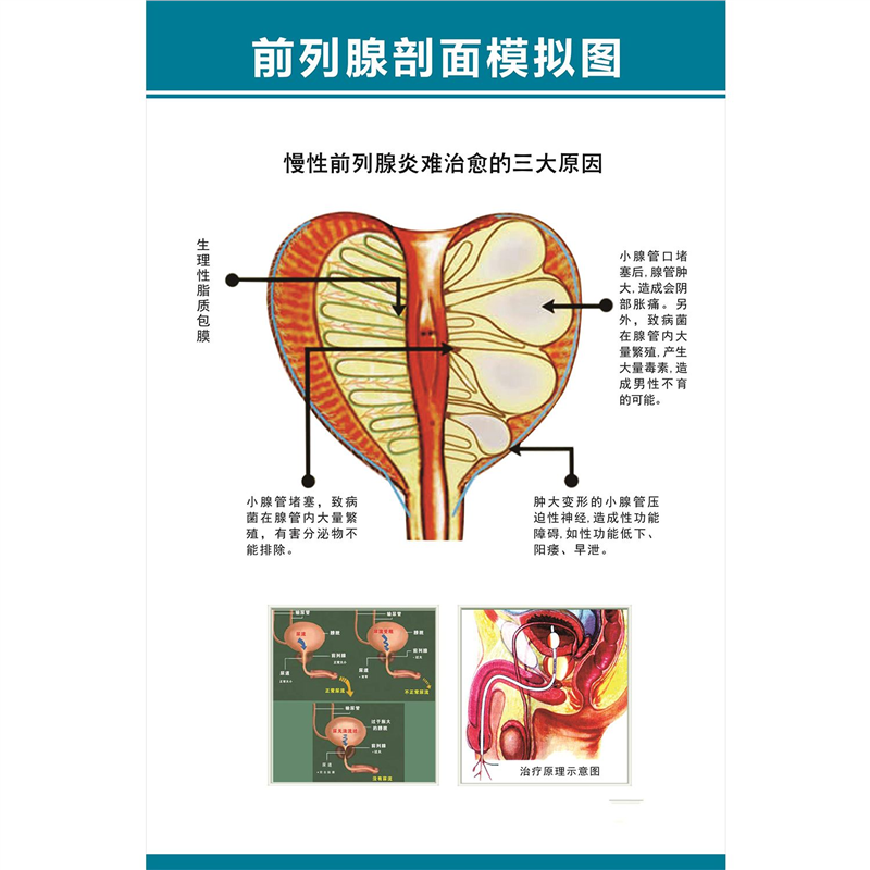 海报印制展板写真医院健康知识男科挂图前列腺剖面模拟图墙贴墙纸,个性定制/设计服务/DIY,写真/海报印制,淘宝优惠券,粉丝福利购,淘宝优惠卷