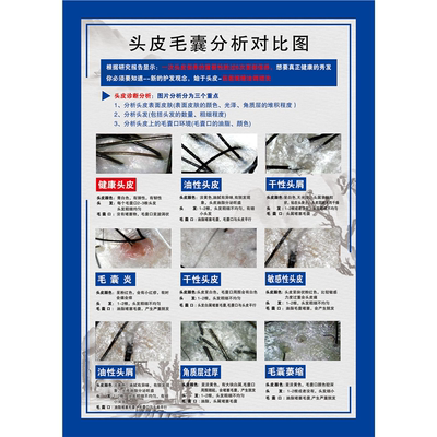 头皮毛囊分析对比图海报展板头皮理疗常见头皮归类毛囊细胞再生术
