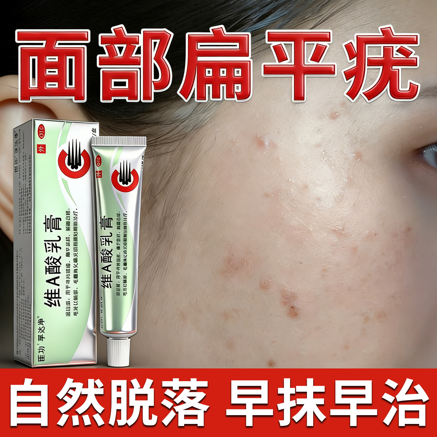 维a酸乳膏医用角化异常引起的扁平疣疙瘩疣瘊肉粒痤疮粉刺专用药