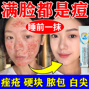阿达帕林凝胶治粉刺丘疹脓包痤疮毛孔粗大去痘痘黑头闭口粉刺专用