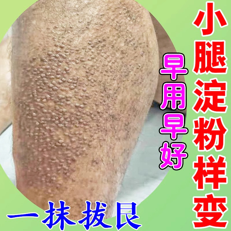 小腿皮肤痒严重神经性红疹过敏痒皮肤淀粉样变专用膏