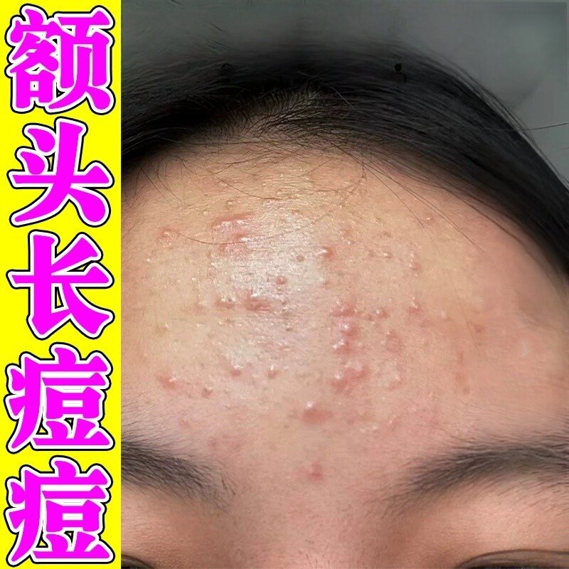 额头痘痘闭口粉刺起小疙瘩去脸上反复长痘痤疮膏除痘印神器