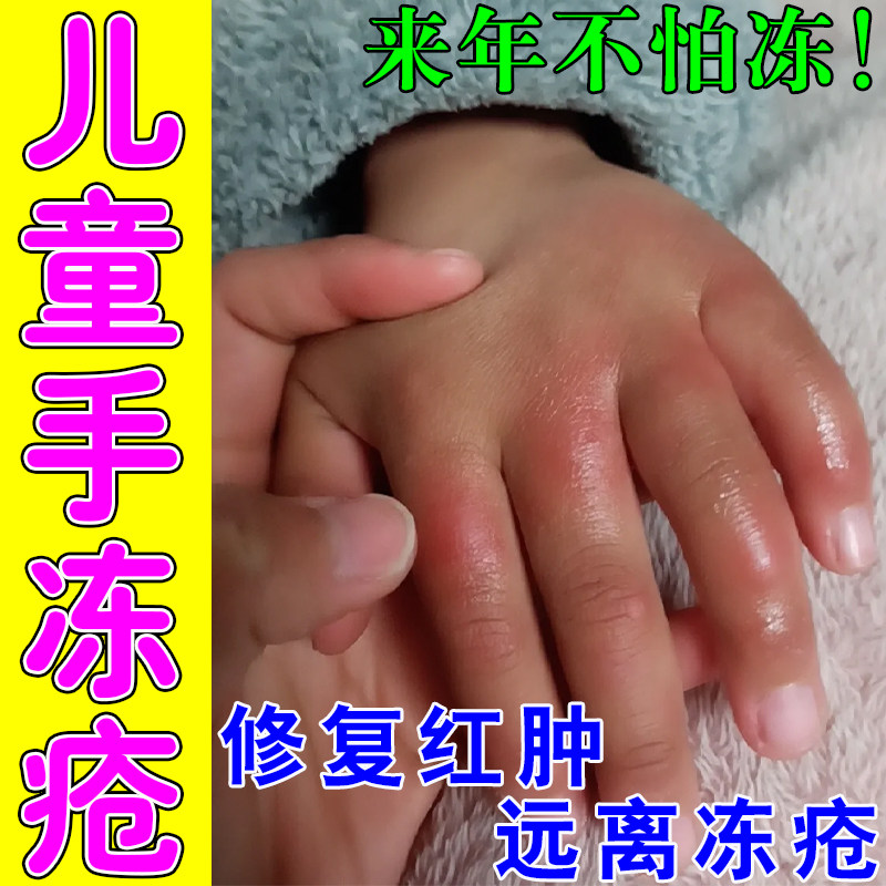 冻疮膏儿童宝宝专用手冻耳朵脸部冻伤红肿裂口滋润冻伤膏神器