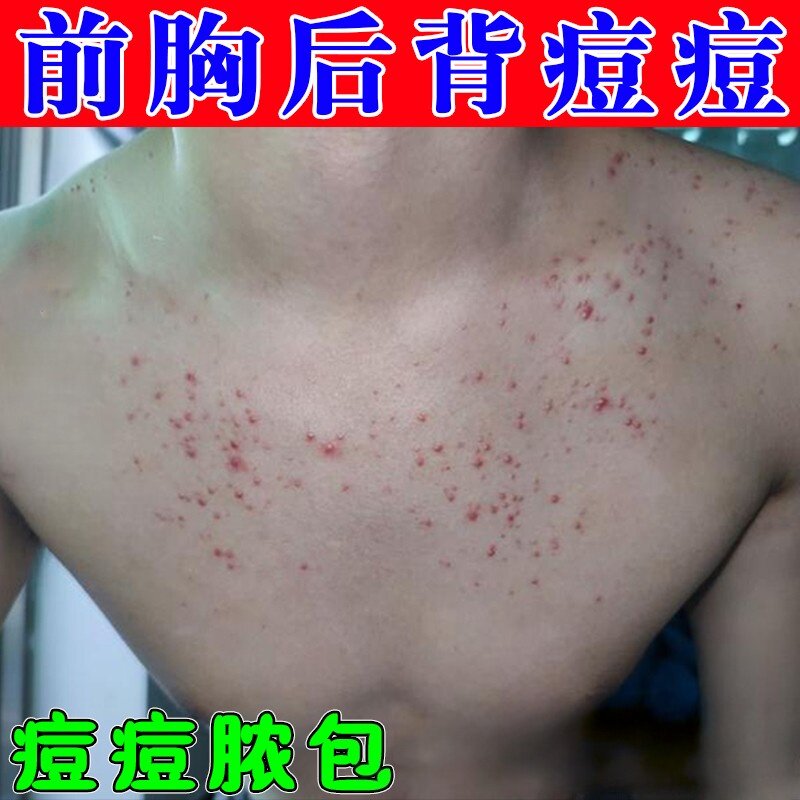 前胸后背痘痘疙瘩毛囊堵塞除马拉色菌专用皮肤长脓包丘诊痒软膏