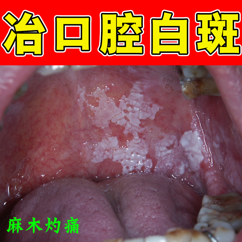 口腔黏膜白斑修复舌头扁平苔网状白纹上颚红肿溃烂糜烂灼痛念珠菌