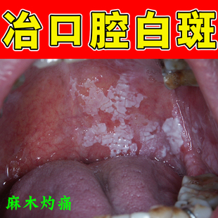 口腔黏膜白斑修复舌头扁平苔网状白纹上颚红肿溃烂糜烂灼痛念珠菌
