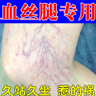 女性腿上红血丝青筋暴起静脉曲张小腿肿胀蚯蚓腿毛细血管扩张修复