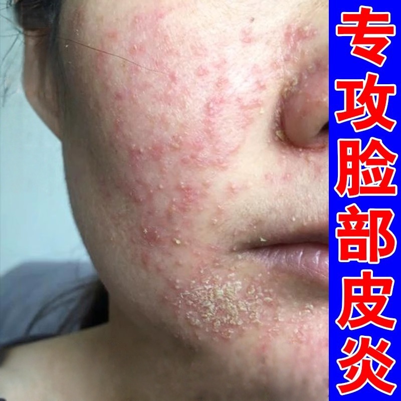 脂溢性皮炎面部专用脸上皮肤过敏发红起疹掉屑无激素修复膏
