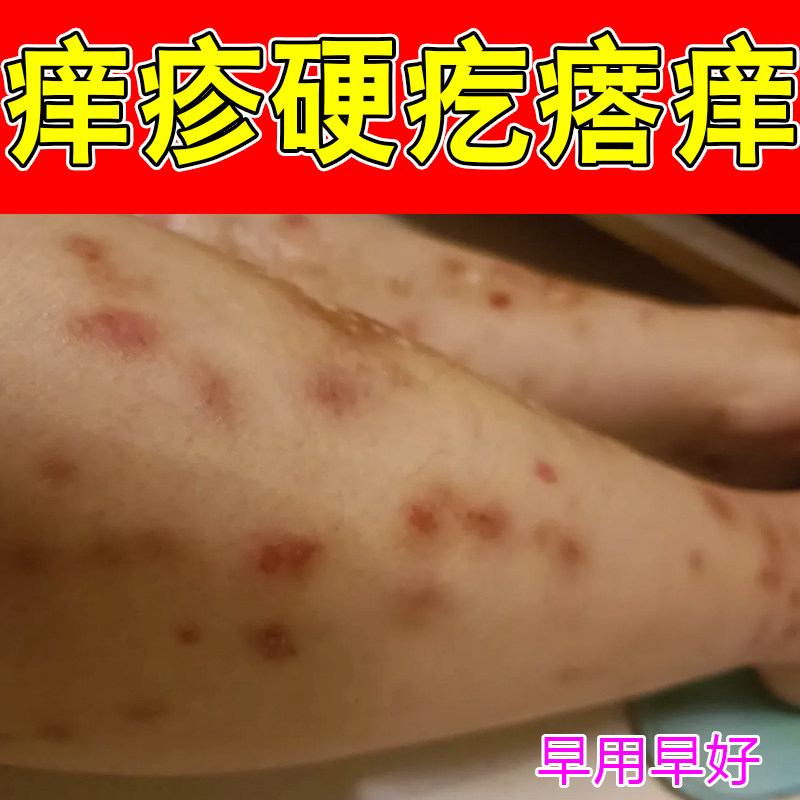 身上硬疙瘩痒红斑顽固痒掉屑腿上红肿四肢躯干长硬块脓包顽固红痒