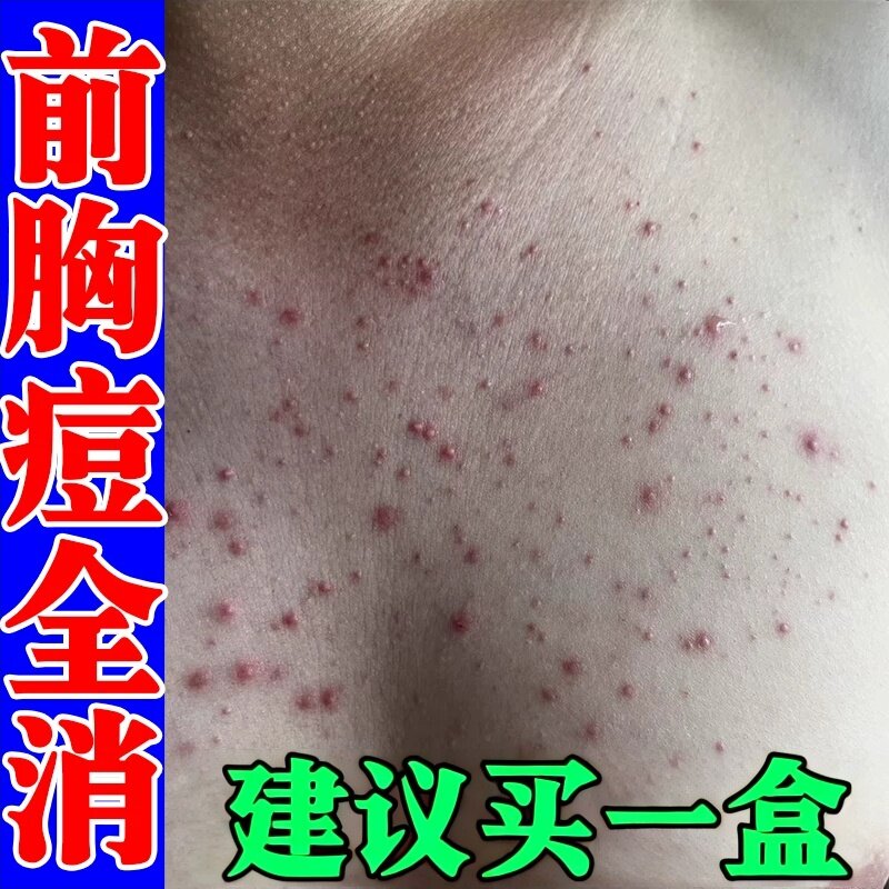 前胸后背长痘痘毛囊膏药胸前痘痘胸口发红发痒长小红点疙瘩专用