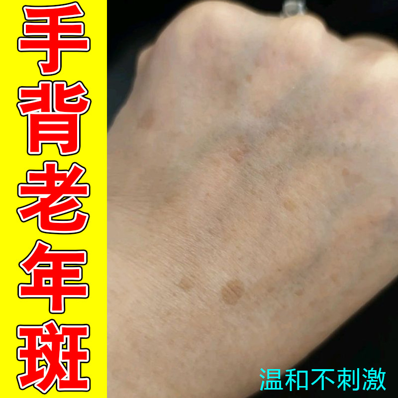 冶手部肌肤匀亮护理乳改善手背色素暗沉中老年手上斑日常呵护润肤