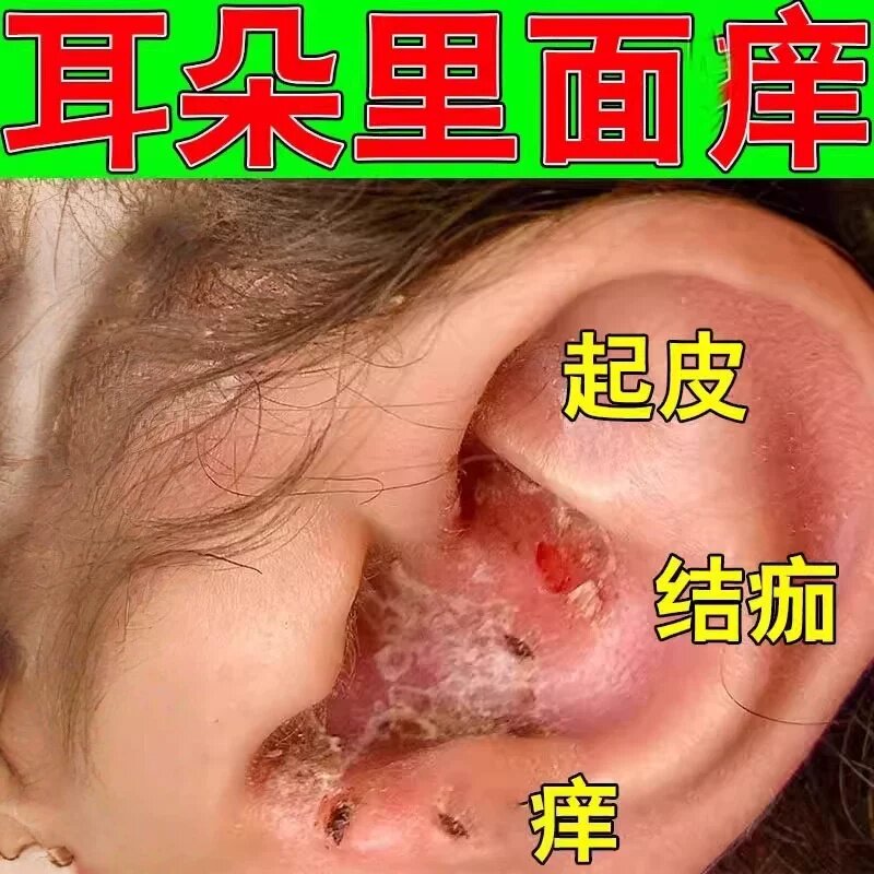 耳朵痒感染外耳道皮屑干燥起皮流脓结痂霉菌性耳道痒专用