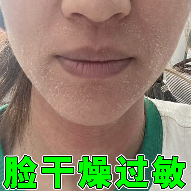脸上起皮干燥脸干掉皮脸部干皮起皮干痒冬天皮肤干燥脱皮护肤润肤