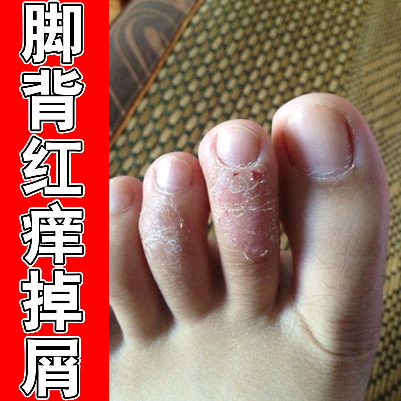 脚背红痒掉屑感染冶脚底长小水泡粗糙脚趾缝蜕皮泛白红痒脚臭脚汗