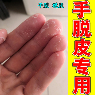 剥脱性角质松懈症儿童手脚严重脱皮手掌心干燥裂专用修复
