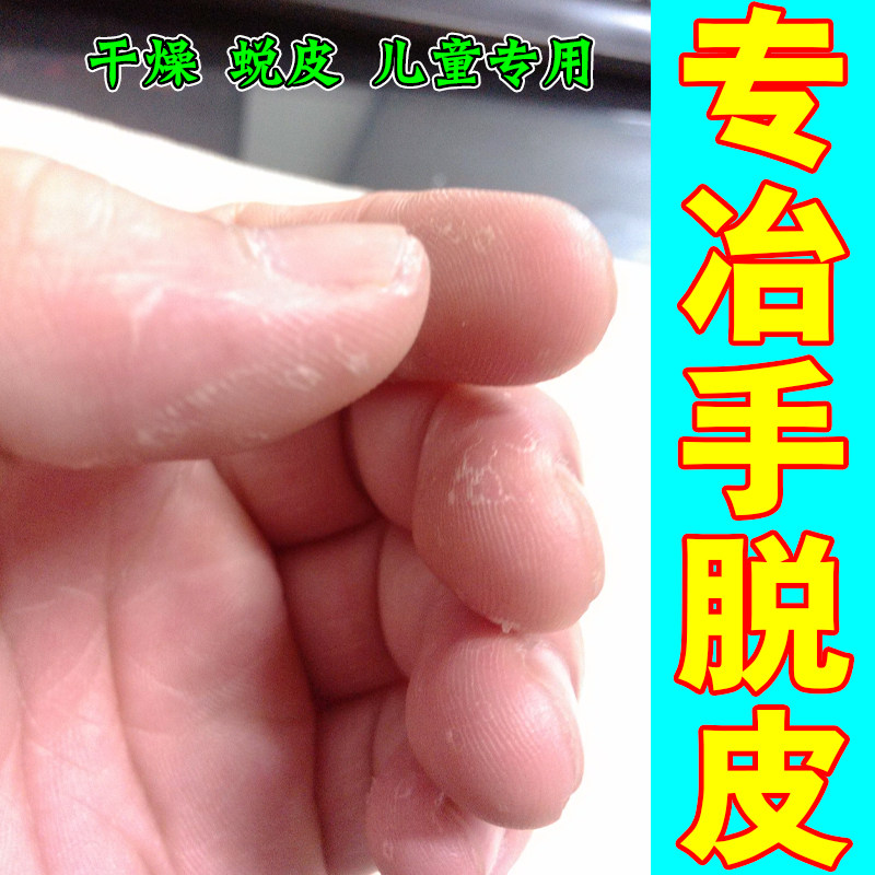 手脱皮手指裂口干燥粗糙手指头开裂干裂脱皮真菌感染修复专冶手裂