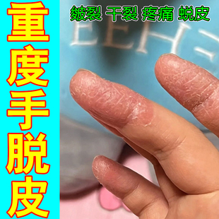 重度手脱皮剥脱性角质松懈症皮肤干燥粗糙起皮掉皮起屑修复