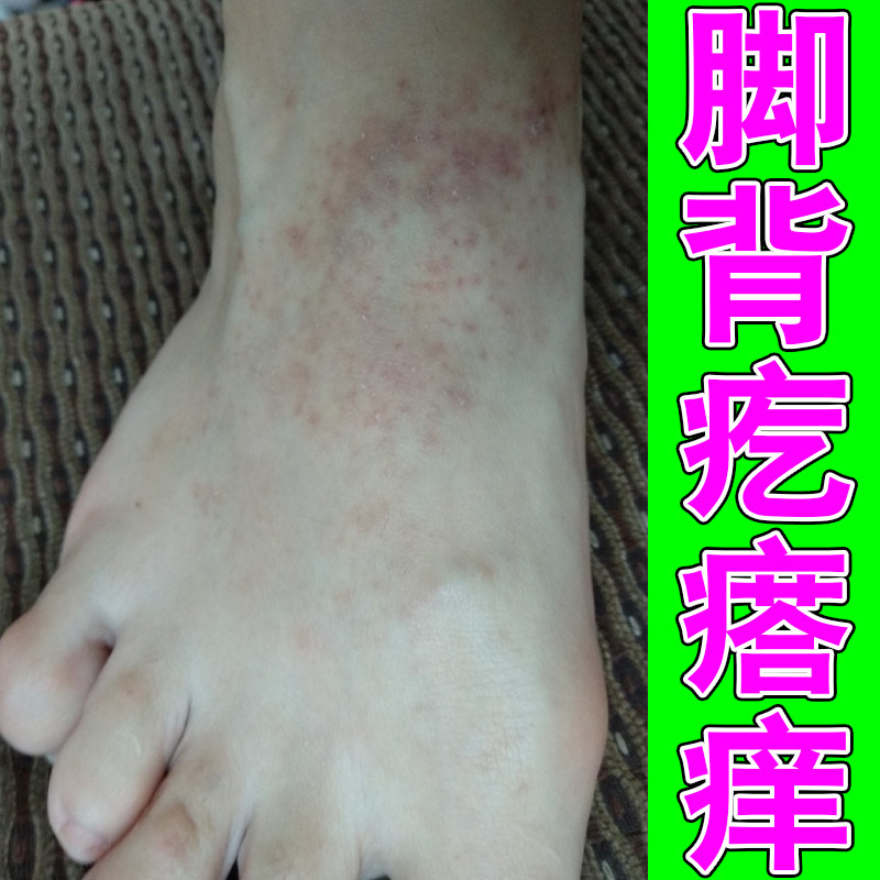 脚背疙瘩痒脚踝起疹子痒角化型脚趾缝泛白痒粗糙干燥痒外用修护药