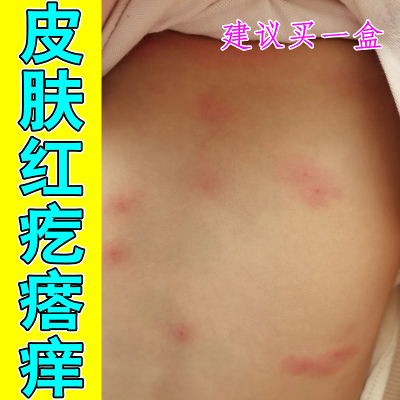 皮肤红疙瘩痒掉屑粗糙皮肤红点小孩儿身上长疹子过敏换季后背刺挠