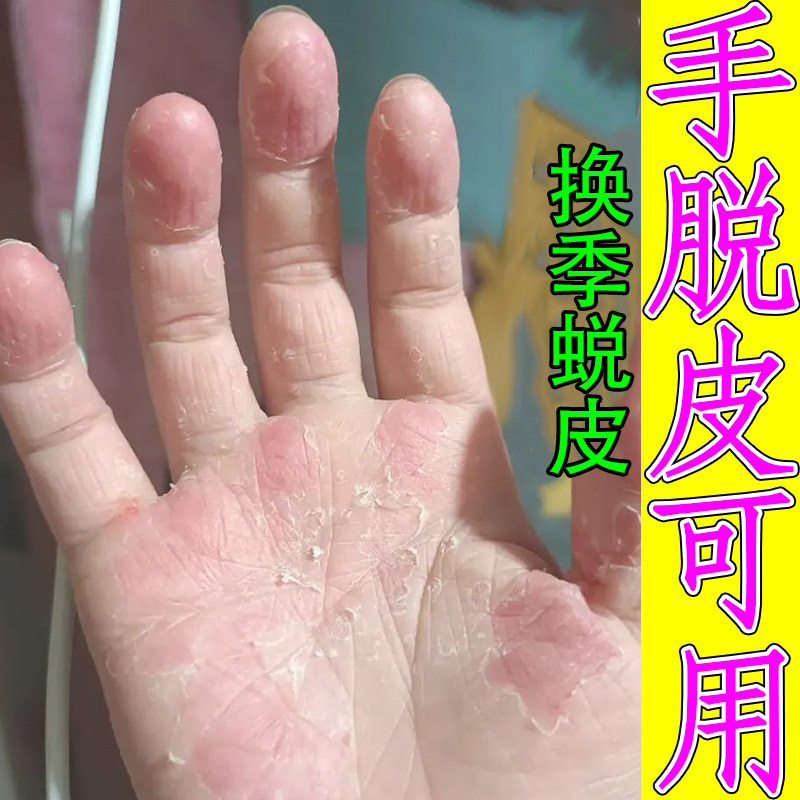 手脱皮感染小孩手指头蜕皮手掌心脱皮指甲边缘发干发硬外用膏药乳