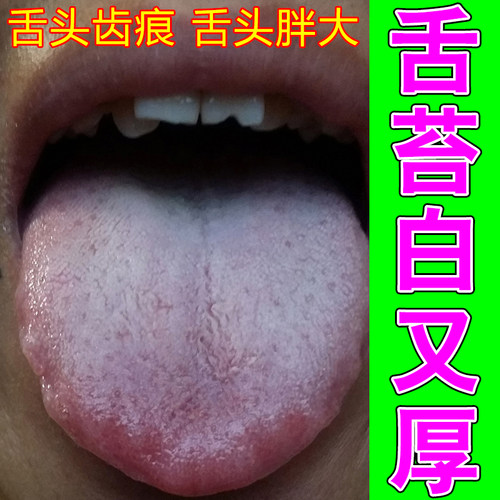 舌苔白厚伴随裂纹舌象异常日常护理水温和呵护舌面口腔舒缓清爽护