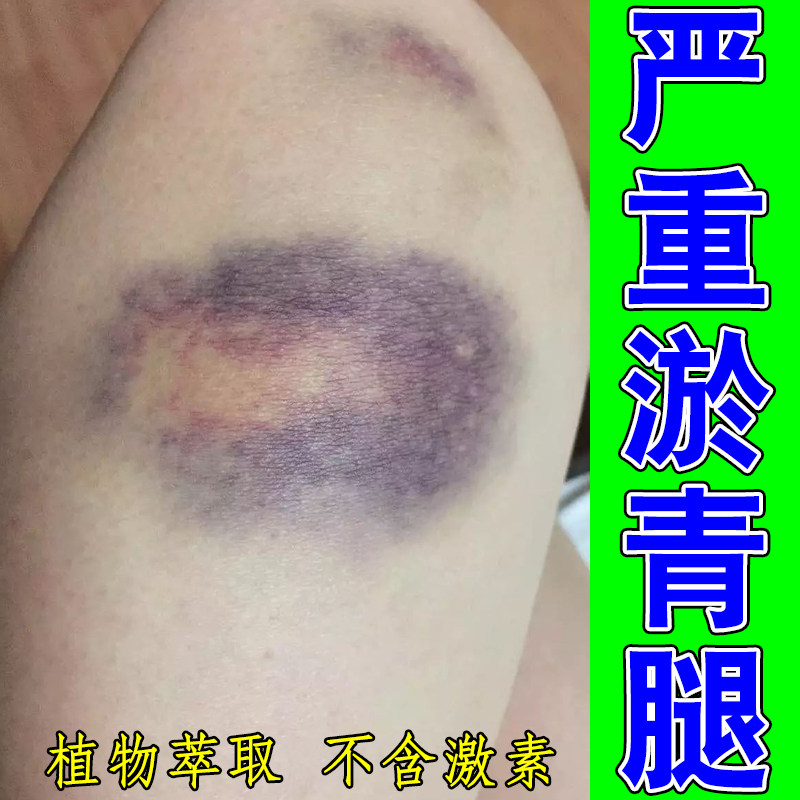 冶腿部磕碰留下青紫色斑块大腿小腿碰撞后乌青块皮下泛红发紫磕碰