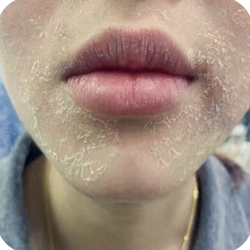 脸上干燥脱皮起皮掉皮干皮脸干痒秋冬季皮肤干燥发痒冶全身起干皮