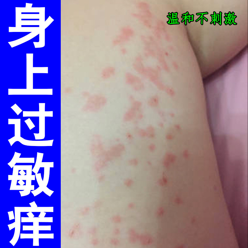 身上过敏痒蚊虫叮咬刺挠干燥痒皮肤长红疙瘩疹子老年人身上痒红肿