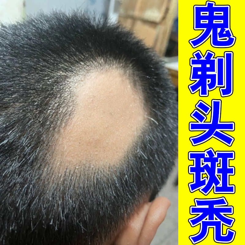 青年斑秃突发局部掉块头发稀少头皮滋养液温和调理发根防片状脱发