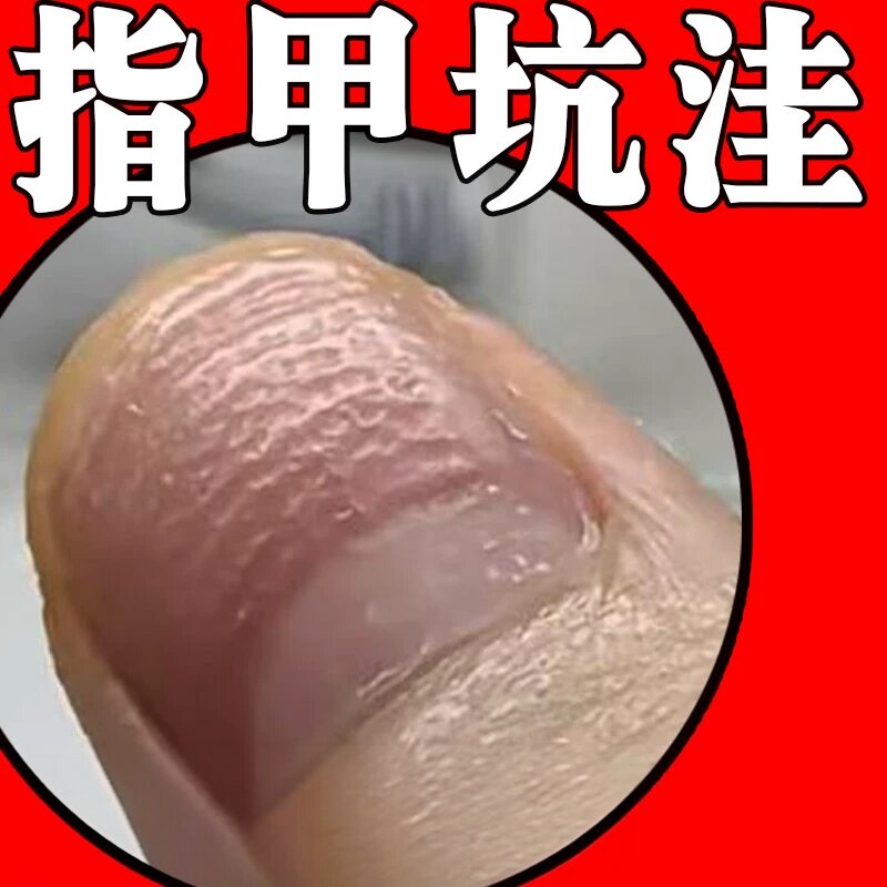 手指甲坑坑洼洼凹凸不平指甲受损凹陷萎缩开裂甲营养不良修复液