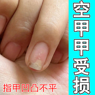 空甲甲受损指甲凹凸不平感染甲发黄分离分层脱落冶啃咬甲修复药液