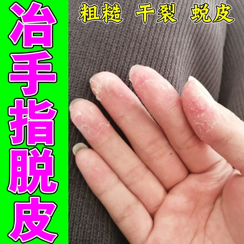 手脱皮严重脱皮专用真菌蜕皮治手干燥裂手指起皮儿童秋冬换季药膏